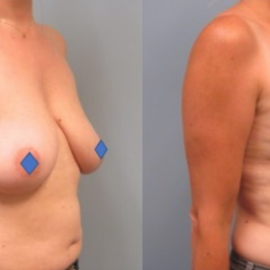Woman standing with shirt off first image is before her breast reduction and the second image is her after her breast reduction showing significant difference.