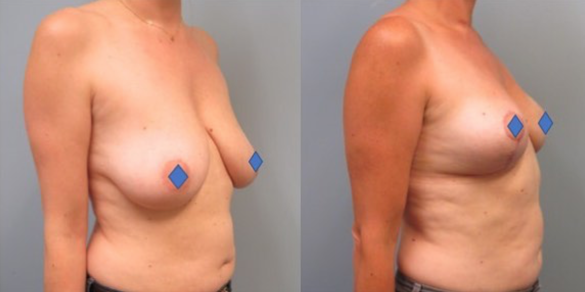 Woman standing with shirt off first image is before her breast reduction and the second image is her after her breast reduction showing significant difference.