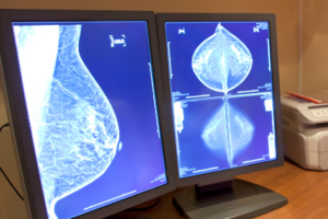 Mammogram Results on Screen Being Reviewed For Breast Cancer.