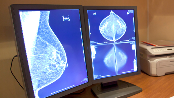 Mammogram Results on Screen Being Reviewed For Breast Cancer.