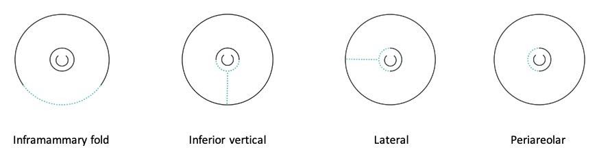 The Double Donut: A Safe and Simple Option for Immediate Nipple Areolar  Complex Reconstruction in Skin-Sparing Mastectomy Patients With  Contraindications to Nipple-Sparing Mastectomy