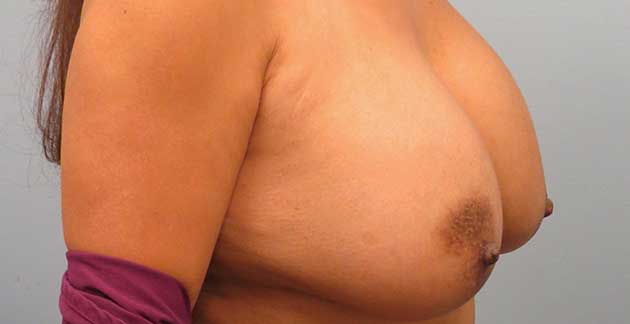 Side view of a patients breast before Anne Peled, MD performed surgery