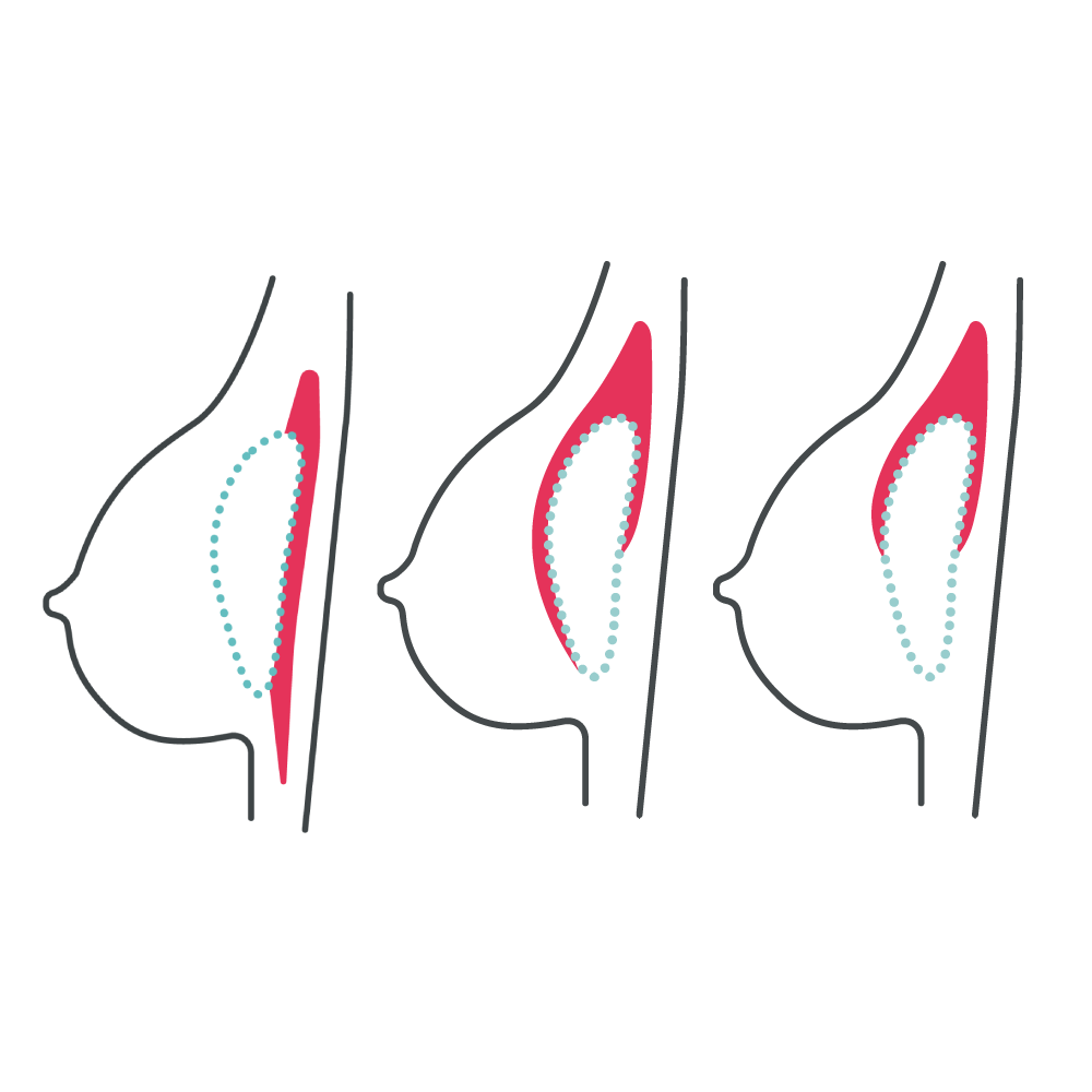 Graphic showing the three different breast implant placement options over the muscle, under the muscle and partially under the muscle also known as dual plane
