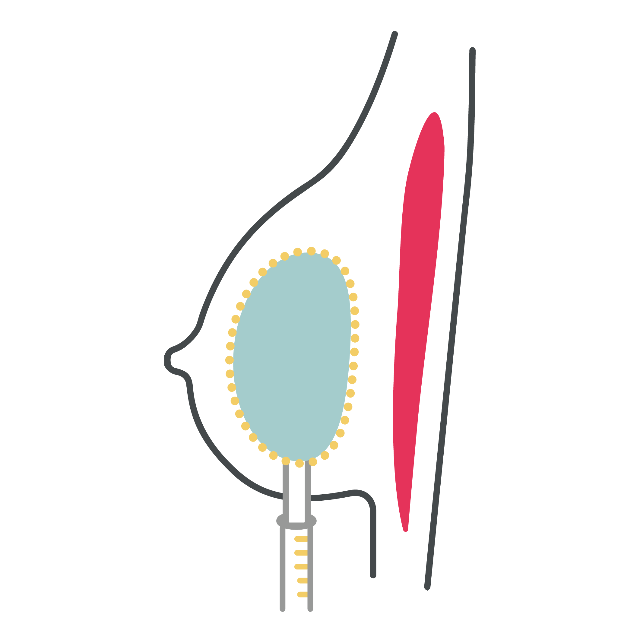 Preservé implant balloon line graphic